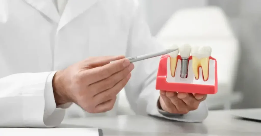 All-on-4 Dental Implants – Full-arch Tooth Replacement with Four Implants
