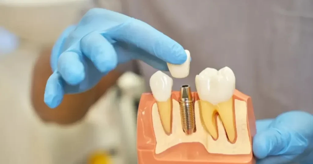 Dental Implants – Titanium Posts for Permanent Tooth Replacement