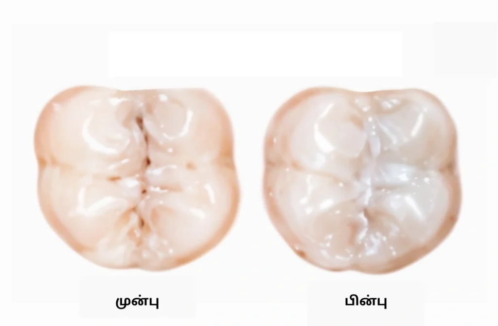 சென்னையில் சிறிய குழந்தைகளுக்கான பல் சிதைவு தடுப்பு