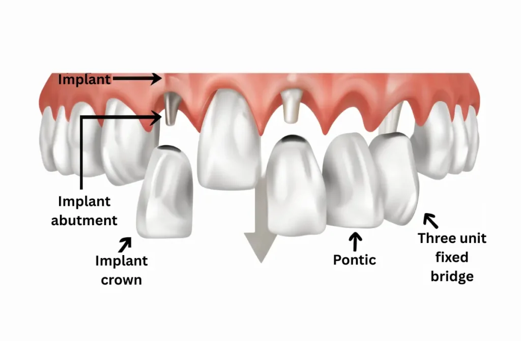 full mouth reconstruction