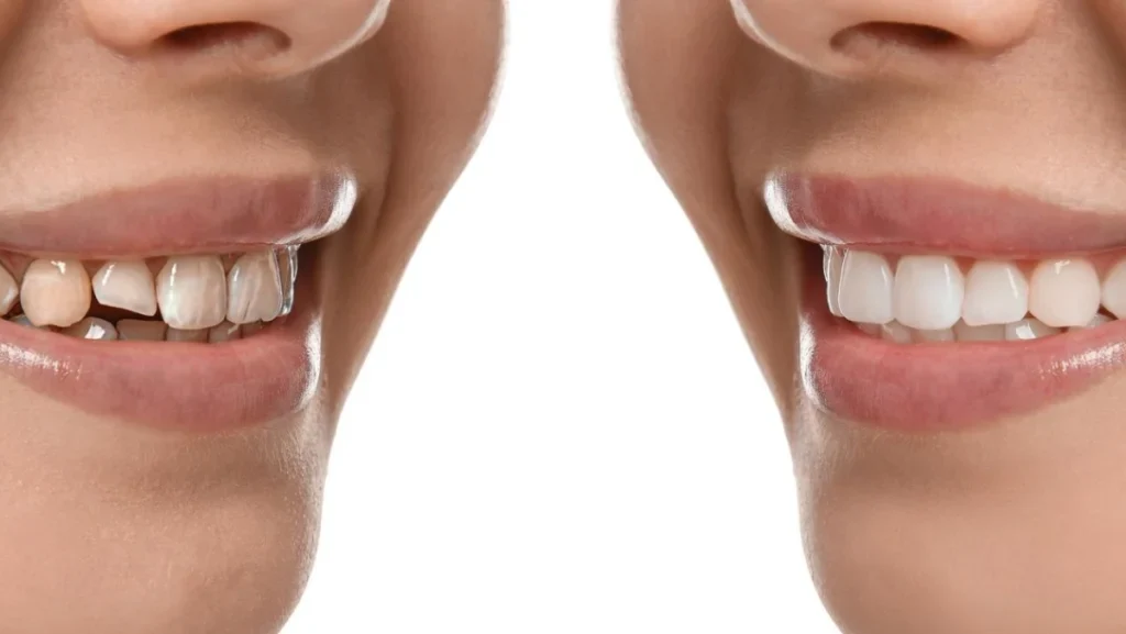 full mouth reconstruction