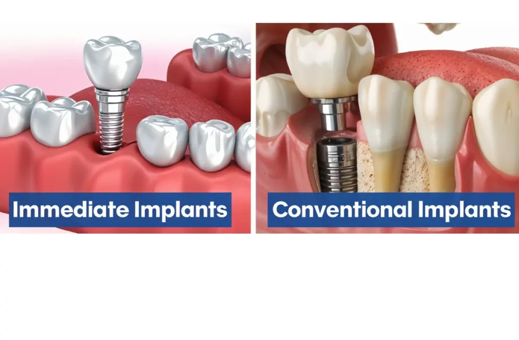 Immediate Load Implants