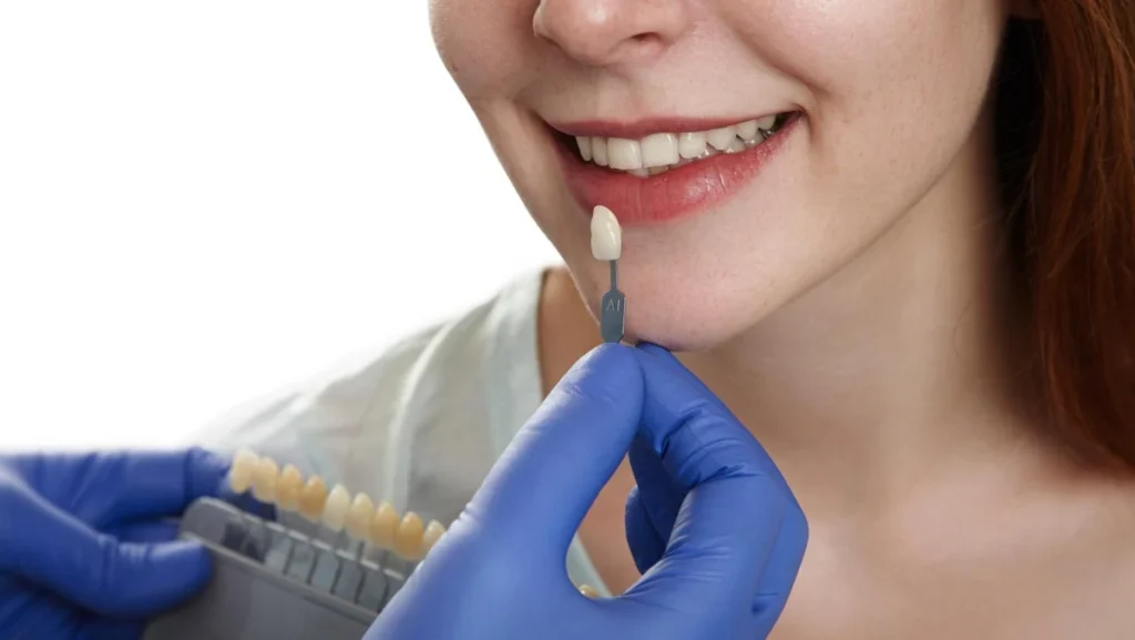 porcelain veneers