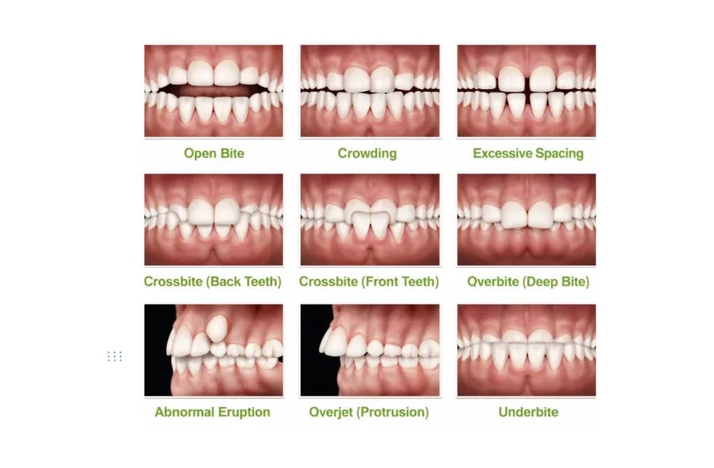 Impact of Orthodontic Treatment on Speech