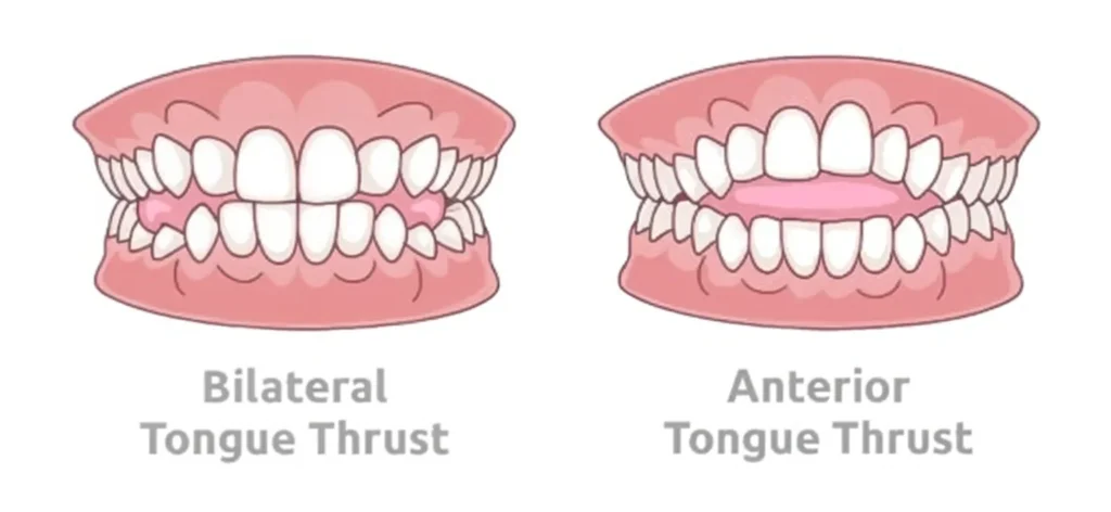 Best Dentist for Tongue Thrusting in Chennai
