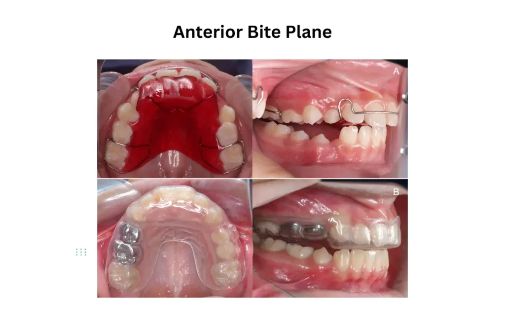 Anterior Bite Plane