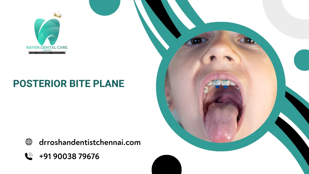 Posterior Bite Plane