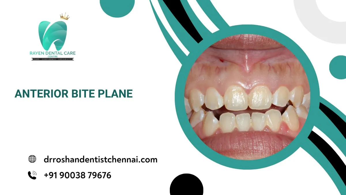 Anterior bite plane