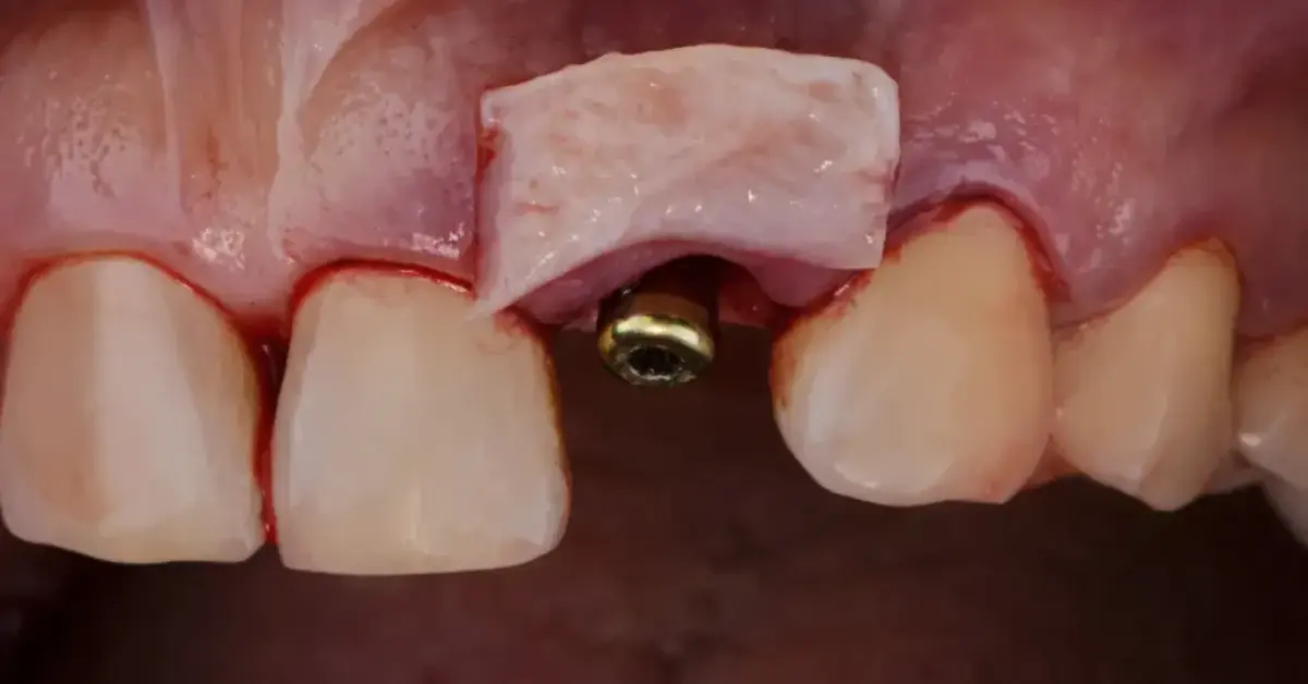 Bone Grafting – Enhancing Jawbone for Implants