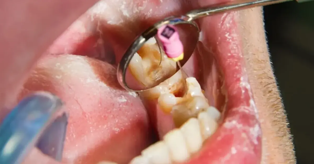 Cavity Filling – Composite, Amalgam, or Glass Ionomer Restorations