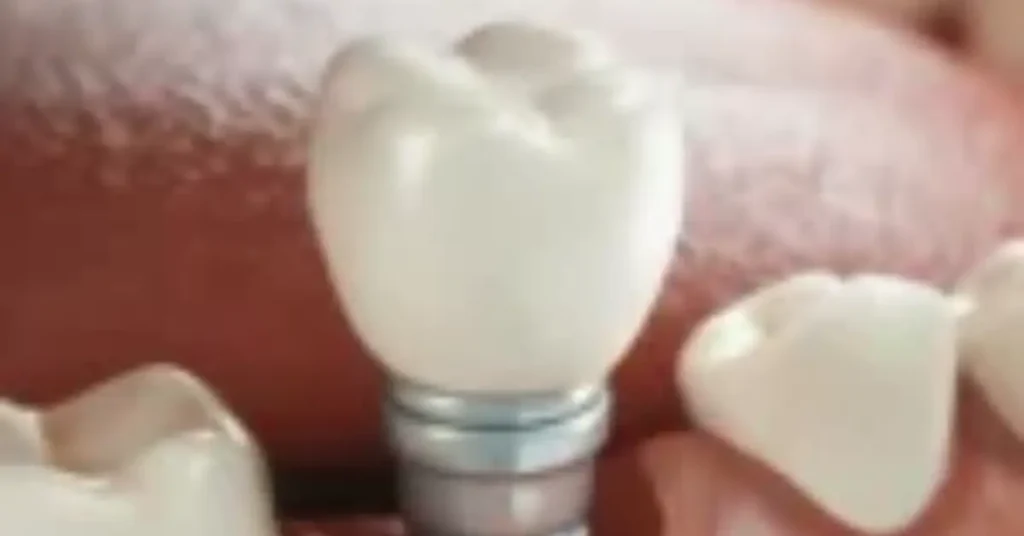 Immediate Load Implants