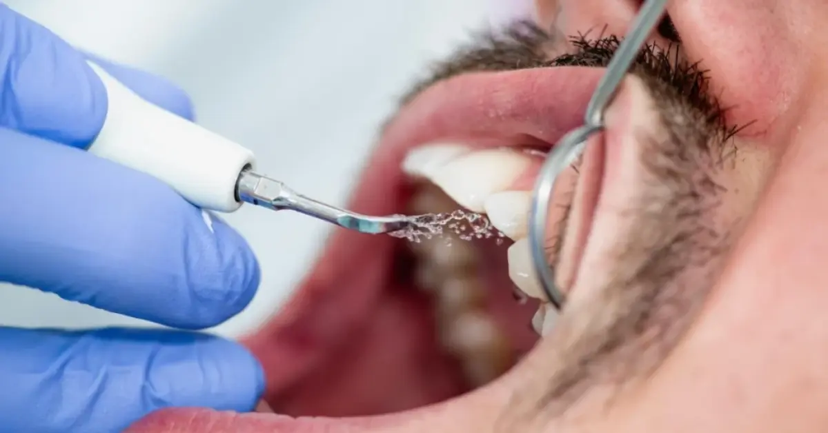 Teeth Cleaning & Scaling