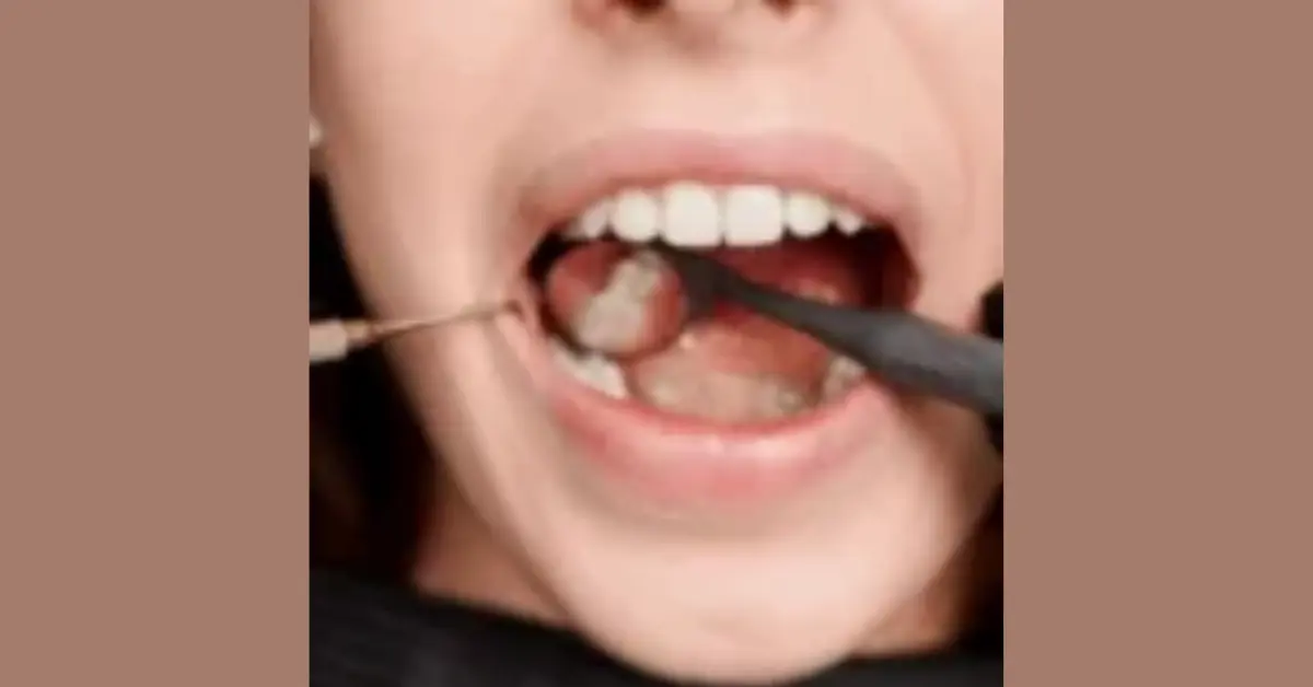 Tooth-Colored Fillings