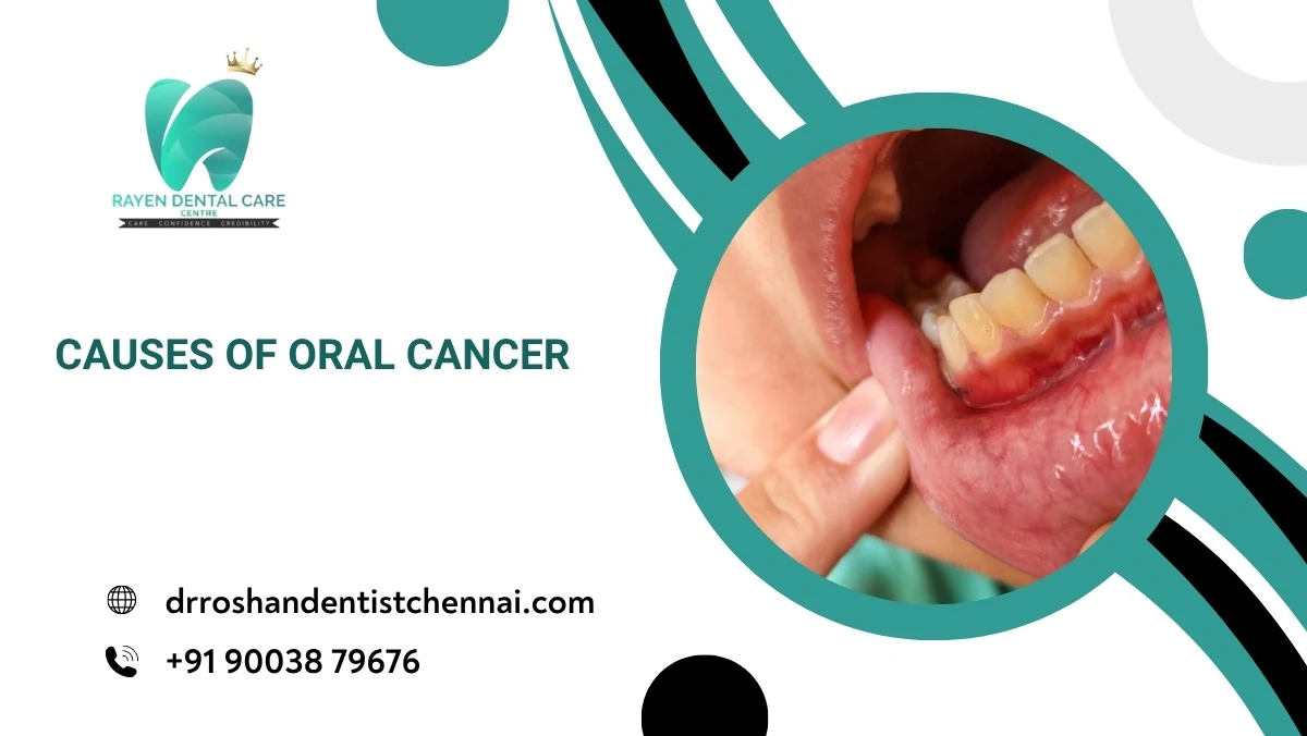 Causes of Oral Cancer