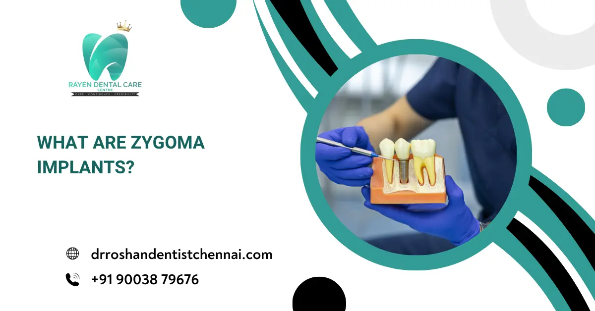 What are Zygoma Implants?