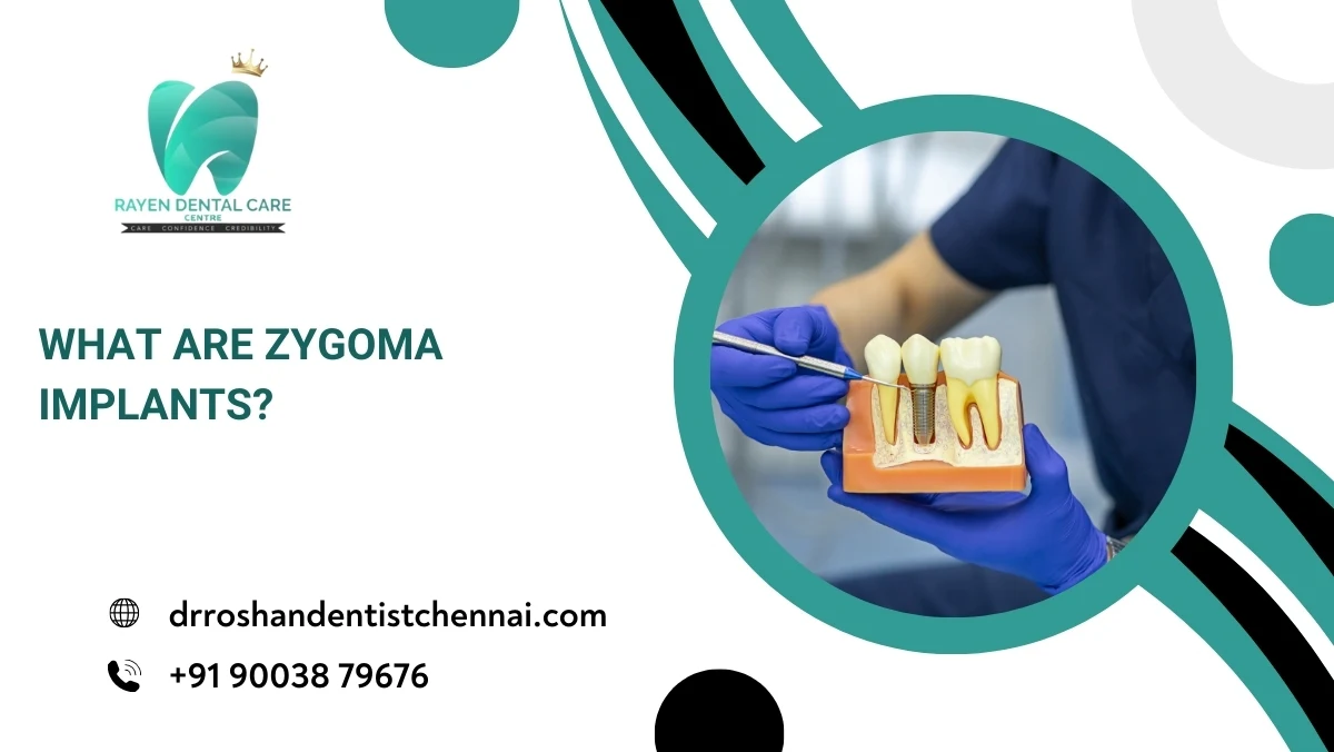 What are Zygoma Implants?