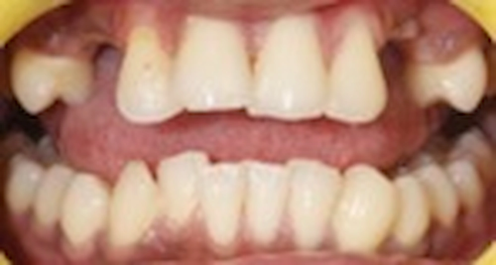 Comprehensive Rehabilitation with Zirconia Implants and Clear Aligner Therapy