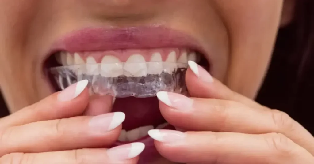 Clear Aligners (Invisalign, Spark, etc.) – Discreet Orthodontic Treatment