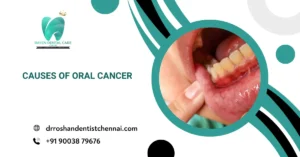 Causes of Oral Cancer